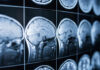MYSTERY Cognitive Decline in Young Adults Close-up of MRI brain scans displayed on a screen