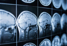 MYSTERY Cognitive Decline in Young Adults Close-up of MRI brain scans displayed on a screen