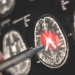 Rare Gene Variant SLASHES Alzheimer’s Risk! A hand pointing at a brain scan with highlighted areas