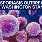 Where Washington stands as the cyclosporiasis outbreak surges | FOX 13 Seattle